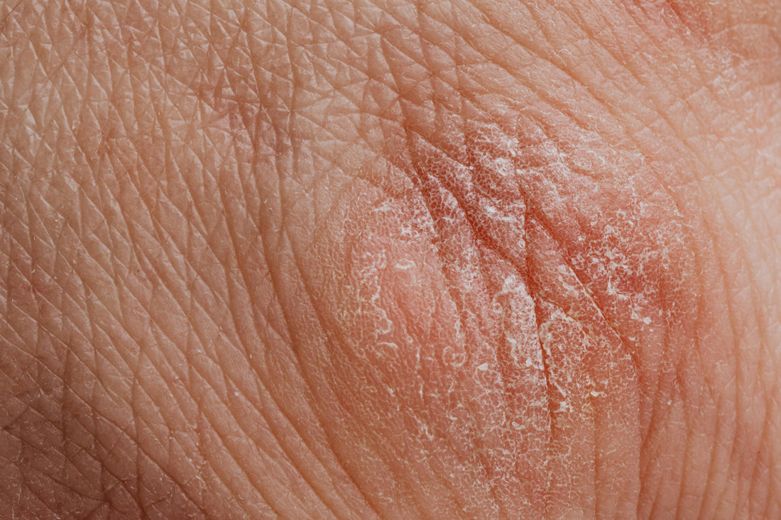 Propolis oil for eczema-prone and inflamed skin