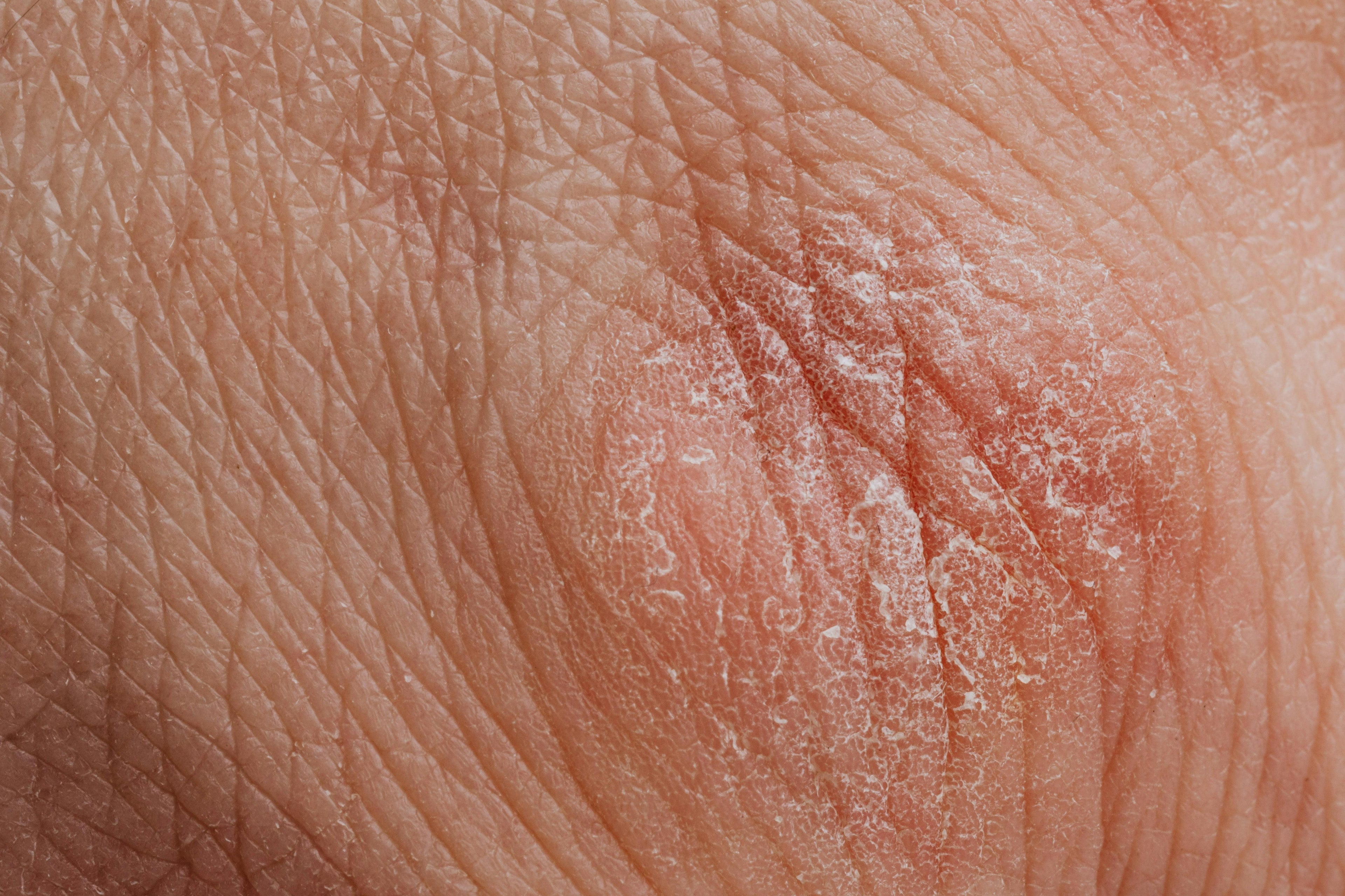 Propolis oil for eczema-prone and inflamed skin